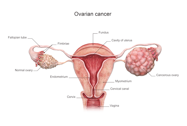 kanser ovari